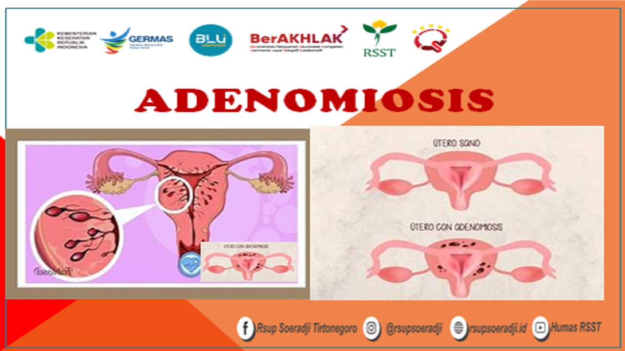 Adenomiosis y menopausia