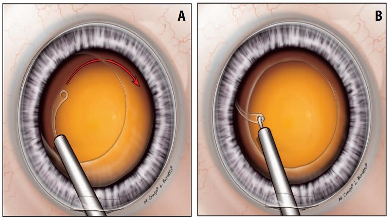 Cionni capsular tension ring placed on the intraocular lens. | Download  Scientific Diagram