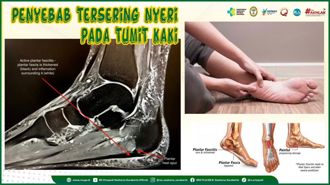 Plantar fasciitis sale terapi